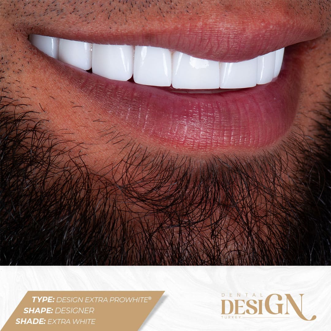 Dental Design Turkey Antalya | Best Dental Implants 16