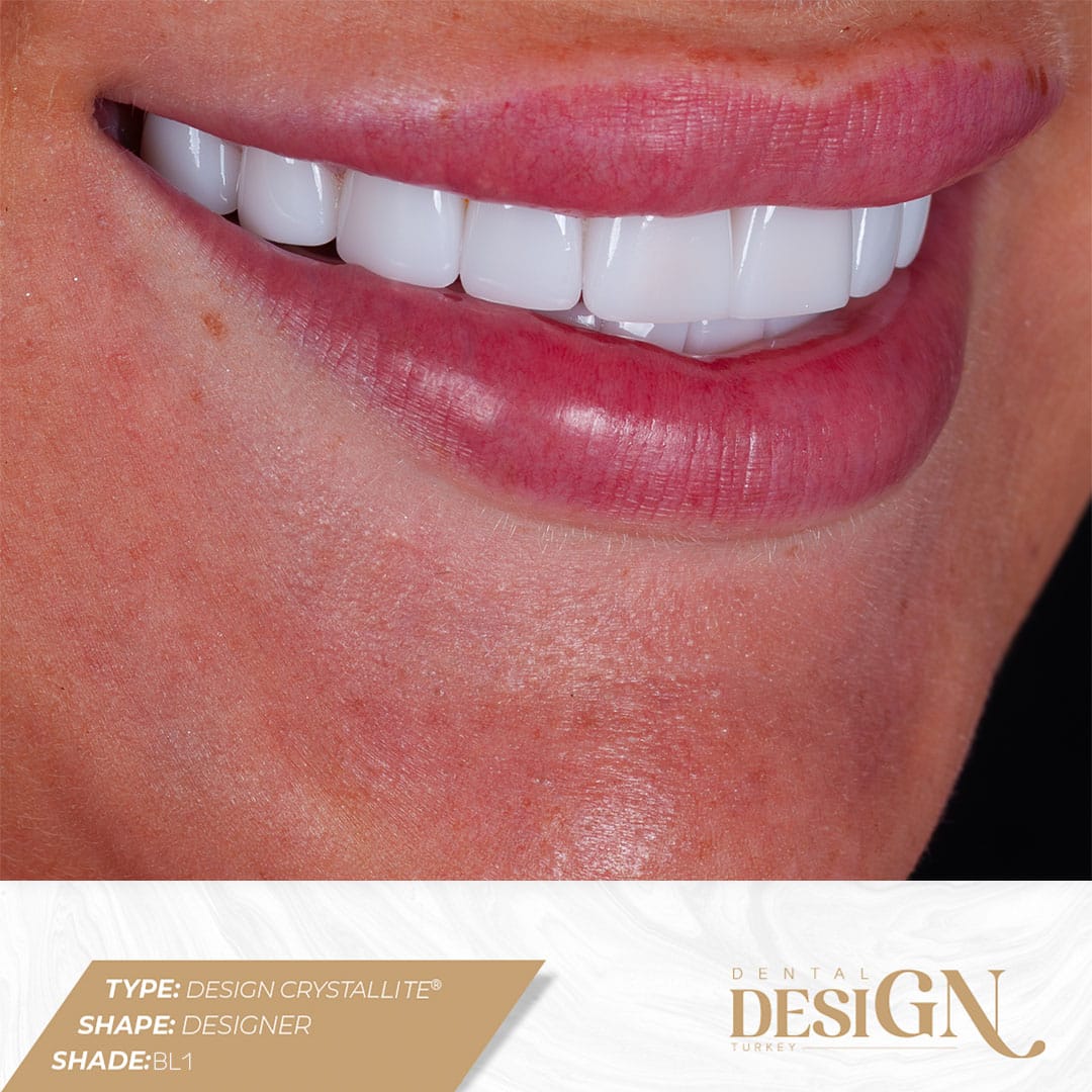 Dental Design Turkey Antalya | Best Dental Implants 13 lamine