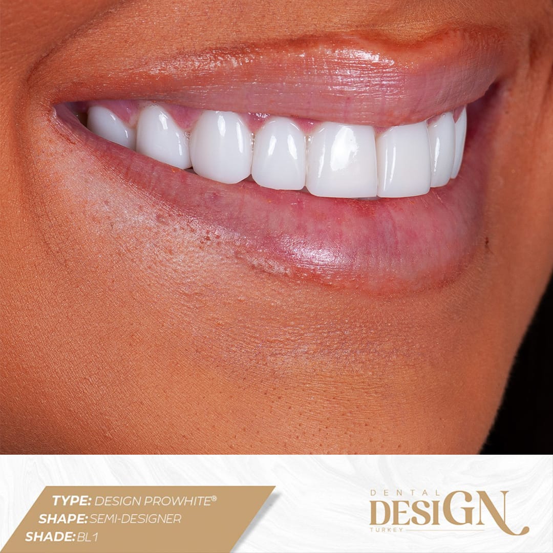 Dental Design Turkey Antalya | Best Dental Implants 14 prowhite